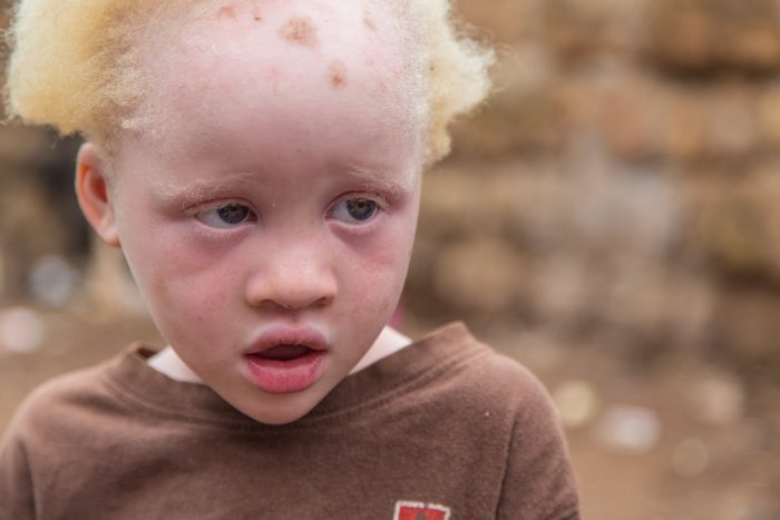 Albinism & Makeup: The Challenges of Choosing a Foundation - Albinism Up  Close