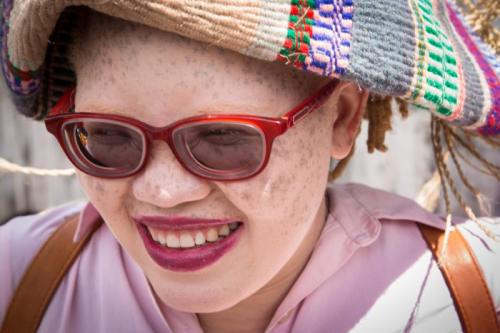 PERSONS WITH ALBINISM 10