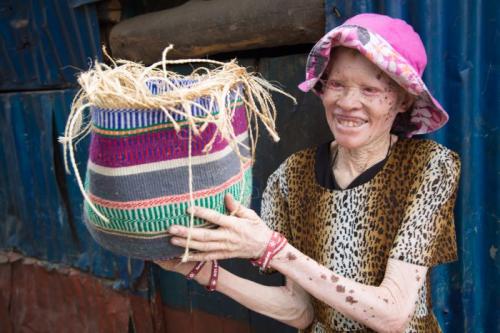 PERSONS WITH ALBINISM 2