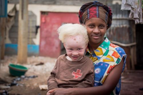 PERSONS WITH ALBINISM 4