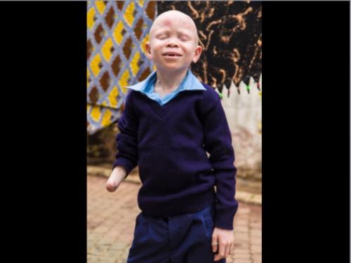 PERSONS WITH ALBINISM 43